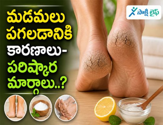 Cracked Heels : మడమలు పగలడానికి కారణాలు-పరిష్కార మార్గాలు..?