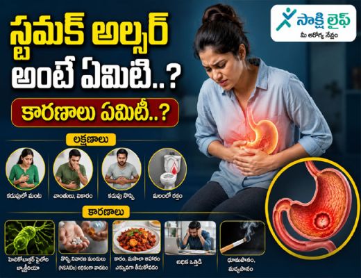 Stomach Ulcer : స్టమక్ అల్సర్ అంటే ఏమిటి..? కారణాలు ఏమిటి..? 