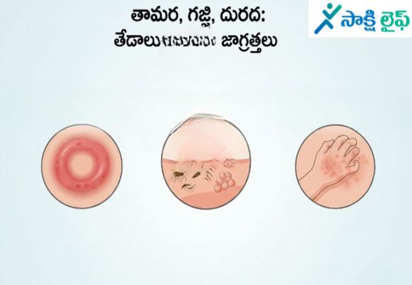 Eczema, Scabies & Itching : తామర, గజ్జి, దురద.. వీటి మధ్య తేడాలు, తీసుకోవాల్సిన జాగ్రత్తలు..