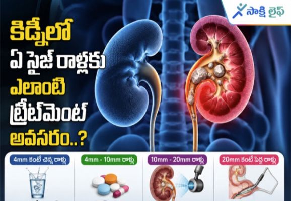 Kidney Stone Treatment : కిడ్నీలో ఏ సైజ్ రాళ్లకు ఎలాంటి ట్రీట్‌మెంట్ అవసరం..?