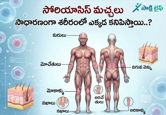 Psoriasis : సోరియాసిస్ మచ్చలు సాధారణంగా శరీరంలో ఎక్కడ కనిపిస్తాయి..? 