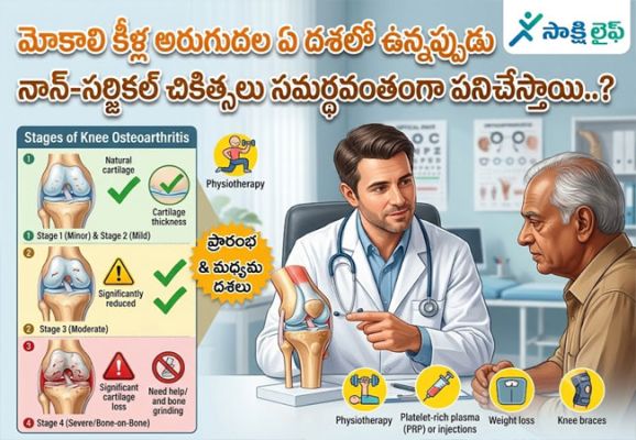 Osteoarthritis : మోకాలి కీళ్ల అరుగుదల ఏ దశలో ఉన్నప్పుడు నాన్-సర్జికల్ చికిత్సలు సమర్థవంతంగా పనిచేస్తాయి..? 