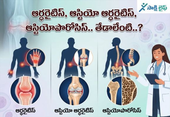 Osteoarthritis vs Osteoporosis : ఆర్థరైటిస్, ఆస్టియో ఆర్థరైటిస్, ఆస్టియోపొరోసిస్.. తేడాలేంటి..? 
