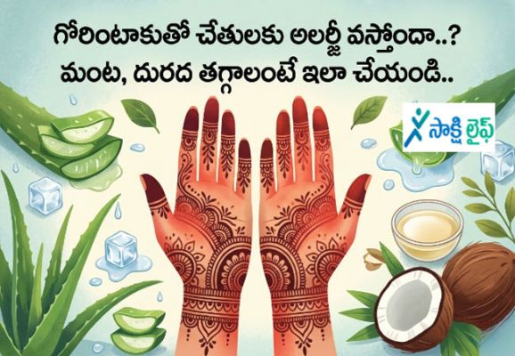 Burning and Itching : గోరింటాకుతో చేతులకు అలర్జీ వస్తోందా..? మంట, దురద తగ్గాలంటే ఇలా చేయండి..
