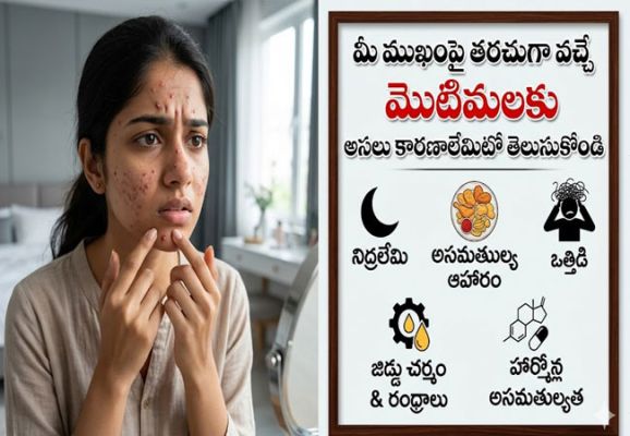 ఒత్తిడి వల్ల మొటిమలు ఎక్కువవుతాయా..? 